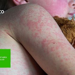 Ciudad de México refuerza medidas contra sarampión por Mundial 2026