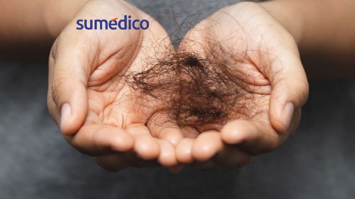 5 alimentos que aceleran la caída del cabello