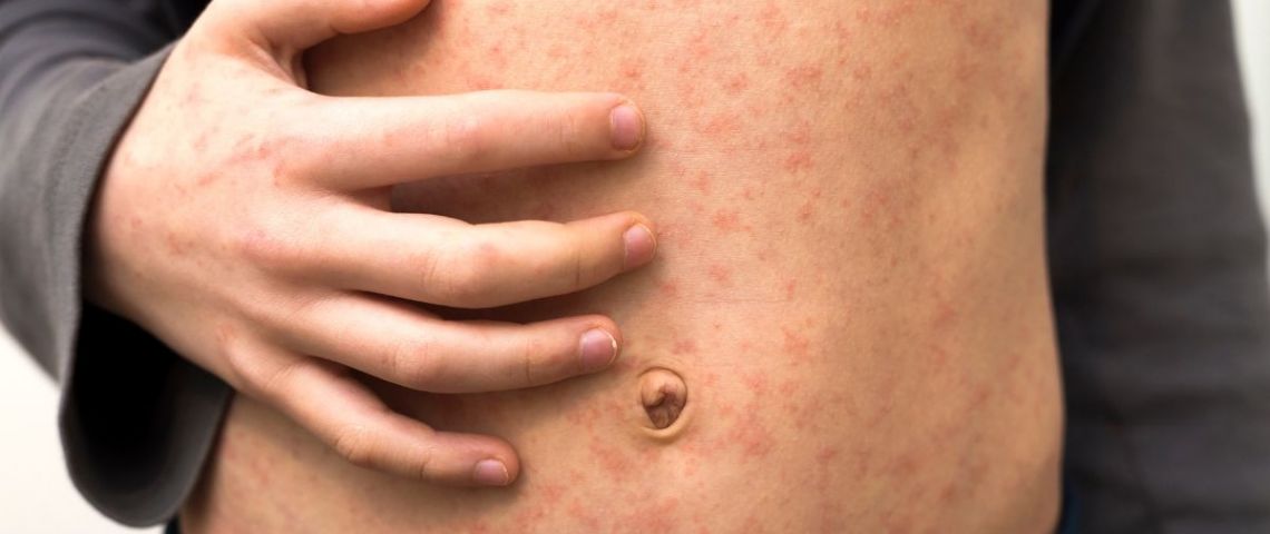 Brote de sarampión avanza mientras hay recorte de recursos a epidemiología y prevención