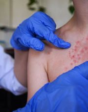 Foto descriptiva de: ¿Hay un caso sospechoso de sarampión en tu escuela o trabajo? Esto es lo que debes hacer