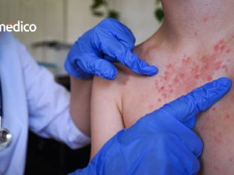 ¿Hay un caso sospechoso de sarampión en tu escuela o trabajo? Esto es lo que debes hacer