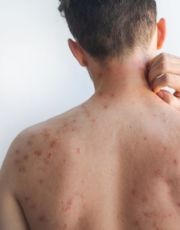 Foto descriptiva de: Mundial de futbol, un riesgo por sarampión, alerta especialista 