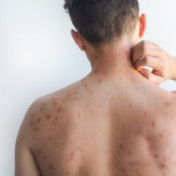 Mundial de futbol, un riesgo por sarampión, alerta especialista 