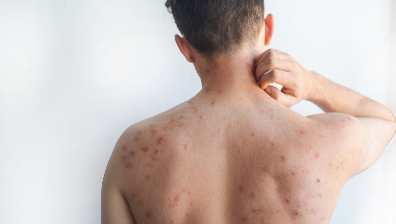 Mundial de futbol, un riesgo por sarampión, alerta especialista 