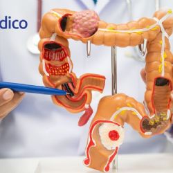 ¿Cómo protegerte del cáncer colorrectal?