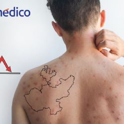 Brote de sarampión en Jalisco registra tendencia a la baja
