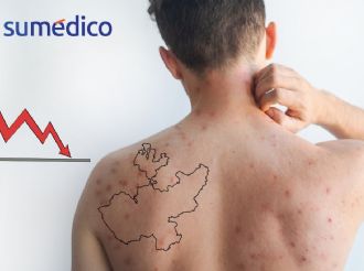 Brote de sarampión en Jalisco registra tendencia a la baja