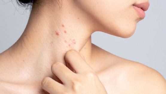 ¿Vacunarte contra el herpes zóster? Este inesperado efecto podría salvar tu corazón