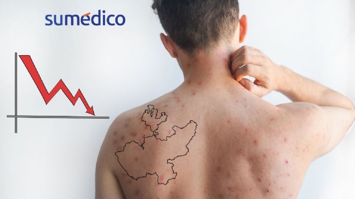 Brote de sarampión en Jalisco registra tendencia a la baja