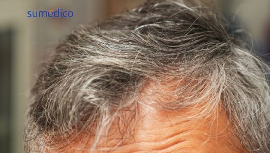 ¿Las canas prematuras te protegen del cáncer?