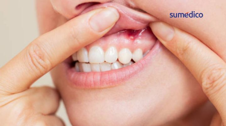 5 señales de diabetes que pueden aparecer en tu boca