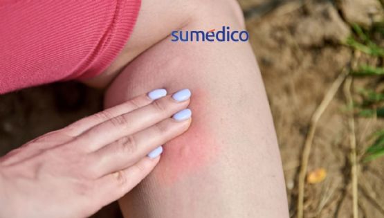 ¿Qué señales indican que tienes chinches en tu casa?