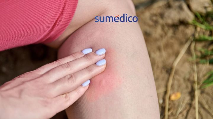 ¿Qué señales indican que tienes chinches en tu casa?