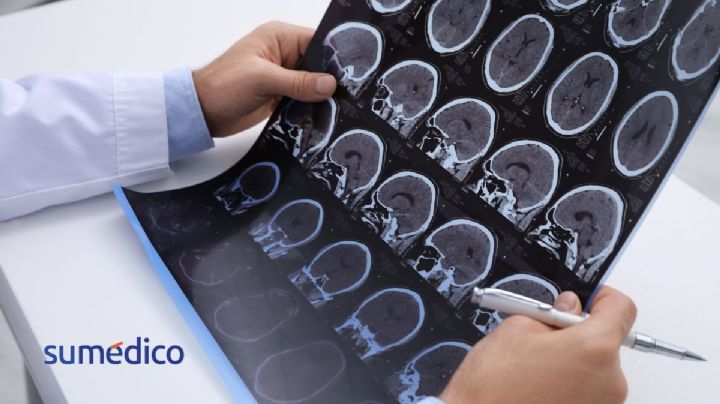 Esclerosis múltiple: la enfermedad que puede tardar hasta 10 años en ser diagnosticada