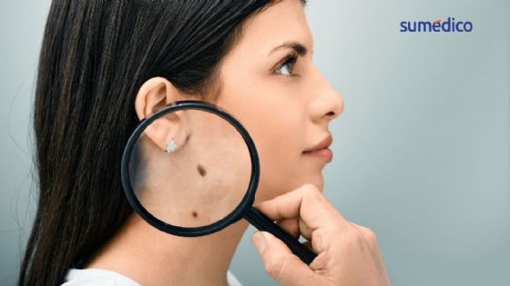 5 señales que indican cáncer de piel y que NO debes de ignorar
