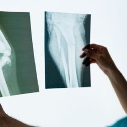  La enfermedad silenciosa que acecha tras la menopausia prematura
