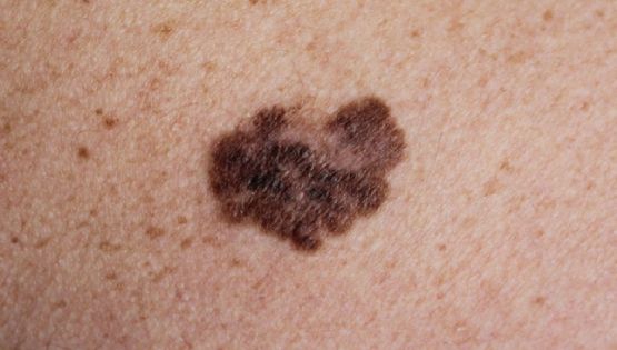 El melanoma que más afecta a los mexicanos y que no es por el sol