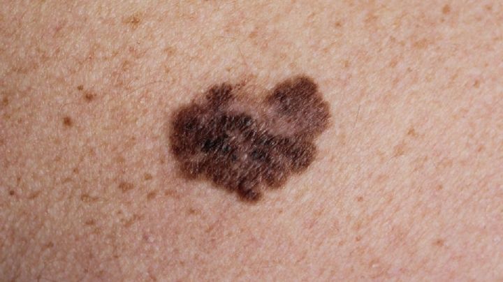 El melanoma que más afecta a los mexicanos y que no es por el sol