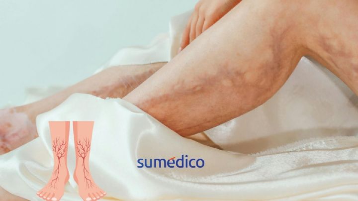 ¿Cómo mejorar la circulación sanguínea en tus piernas?