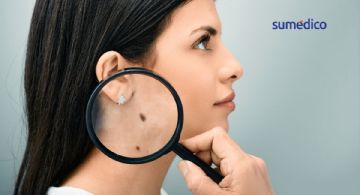 Las señales de cáncer de piel que NO debes ignorar