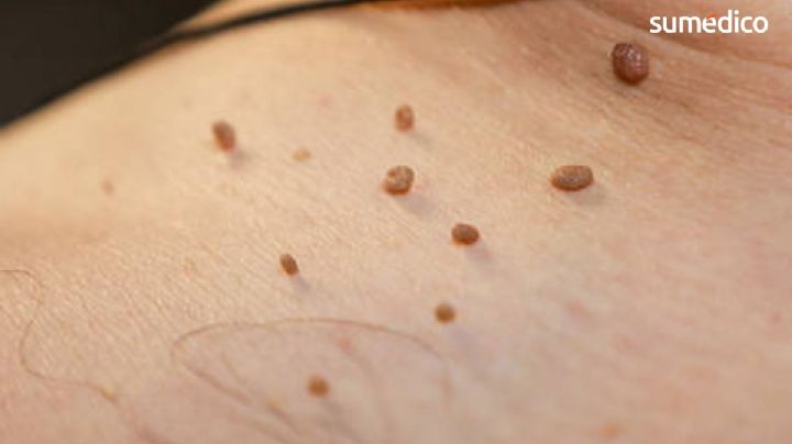 ¿Qué significa que te salgan verrugas en el cuello?