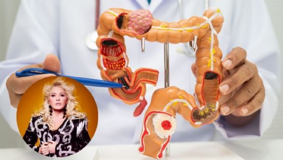 ¿Qué es el cáncer de intestino que padeció Yuri?