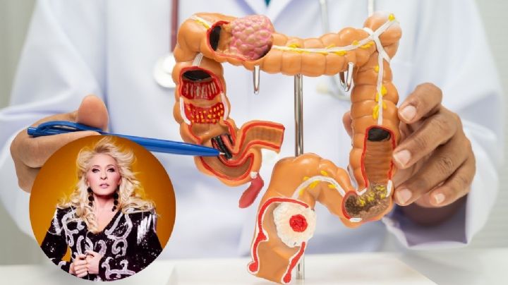 ¿Qué es el cáncer de intestino que padeció Yuri?