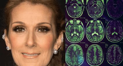 ¿Qué es el síndrome de la persona rígida que padece Céline Dion?