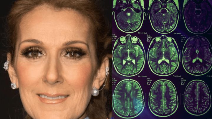 ¿Qué es el síndrome de la persona rígida que padece Céline Dion?