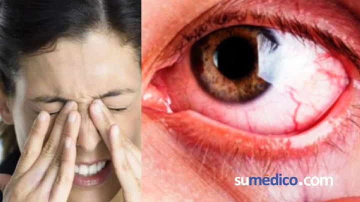Glaucoma: la enfermedad silenciosa que provoca ceguera irreversible