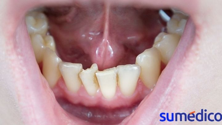 ¿Tienes los dientes ‘chuecos’? Descubre cómo puede afectar a tu salud