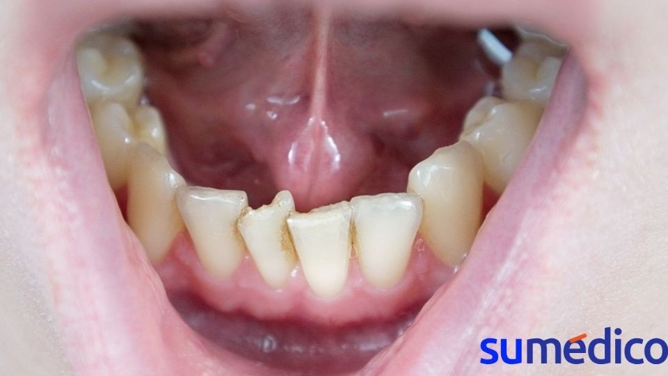 Los dientes chuecos pueden traer problemas de salud.