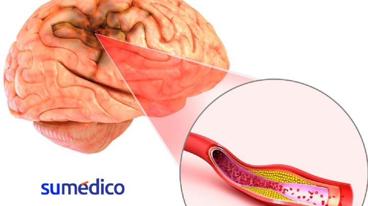 Este gorro de ondas cerebrales permite diagnosticar a tiempo un accidente cerebrovascular