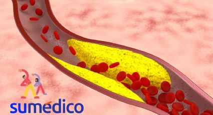 Menor riesgo de padecer ateroesclerosis si realizas este ejercicio