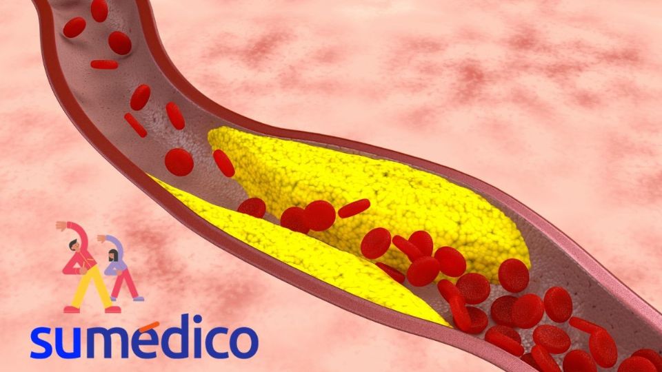 Este ejercicio te ayudará frente la aterosclerosis.