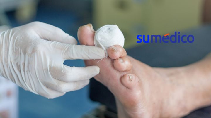Crean gel que cura heridas en diabéticos tres veces más rápido
