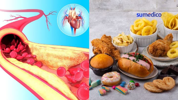 5 alimentos que tapan las arterias