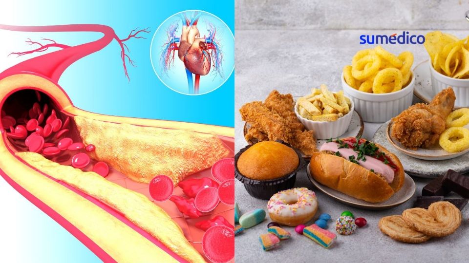 Los alimentos que tapan las arterias son deliciosos, pero nos ponen en riesgo de infartos.