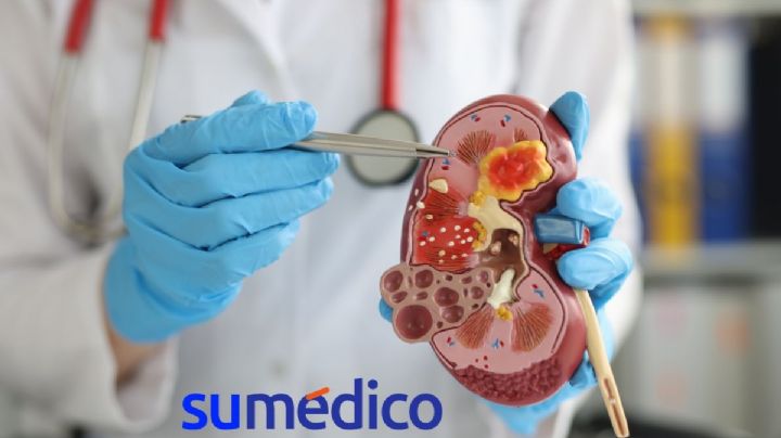 ¿Cuáles son las claves para evitar la enfermedad renal?