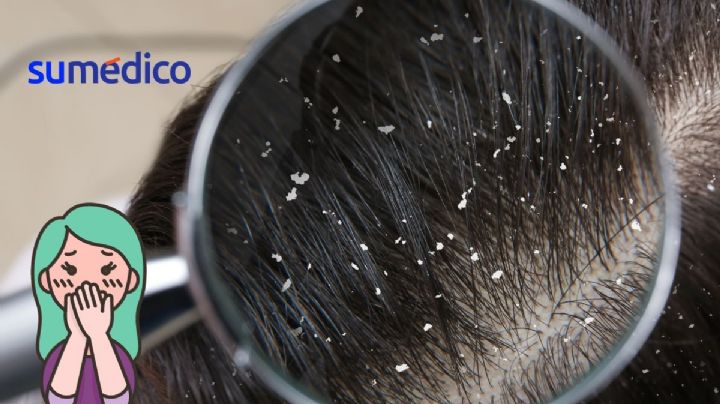 ¿Tienes caspa o liendres? 5 claves para diferenciarlas
