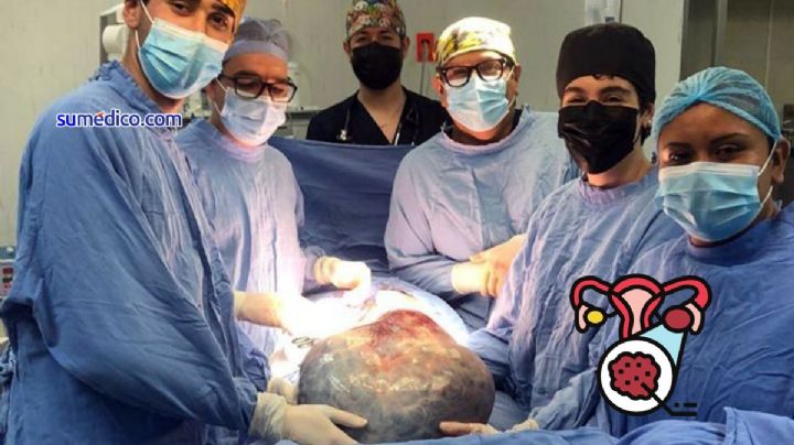 Retiran tumor ovárico gigante de 21 kg a mujer de 60 años