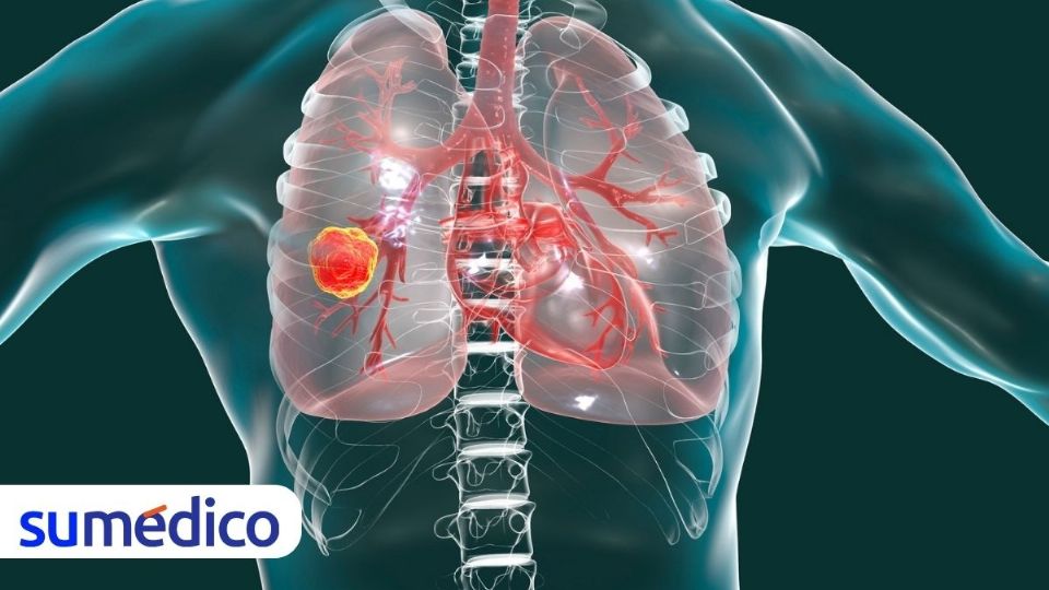 ¿Cómo podría ayudar este test a la detección de cáncer de pulmón?