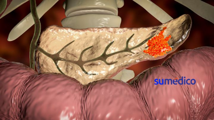 ¿Por qué están aumentando los casos de cáncer de páncreas en jóvenes?