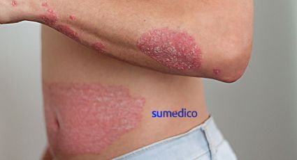 ¿Qué es la psoriasis?