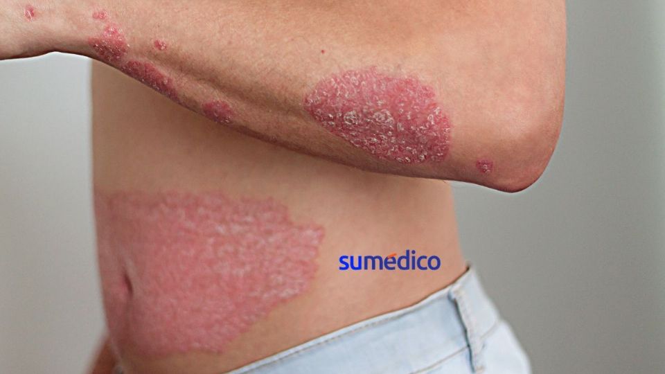 Descubre cómo afecta la psoriasis