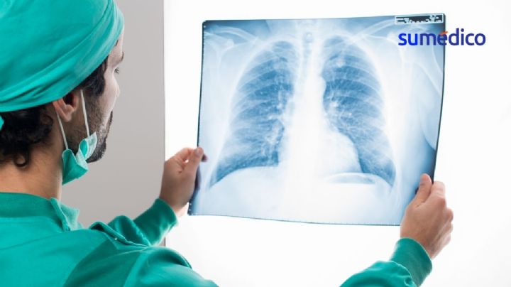 ¿Por qué han aumentado los casos de cáncer de pulmón en mexicanas?