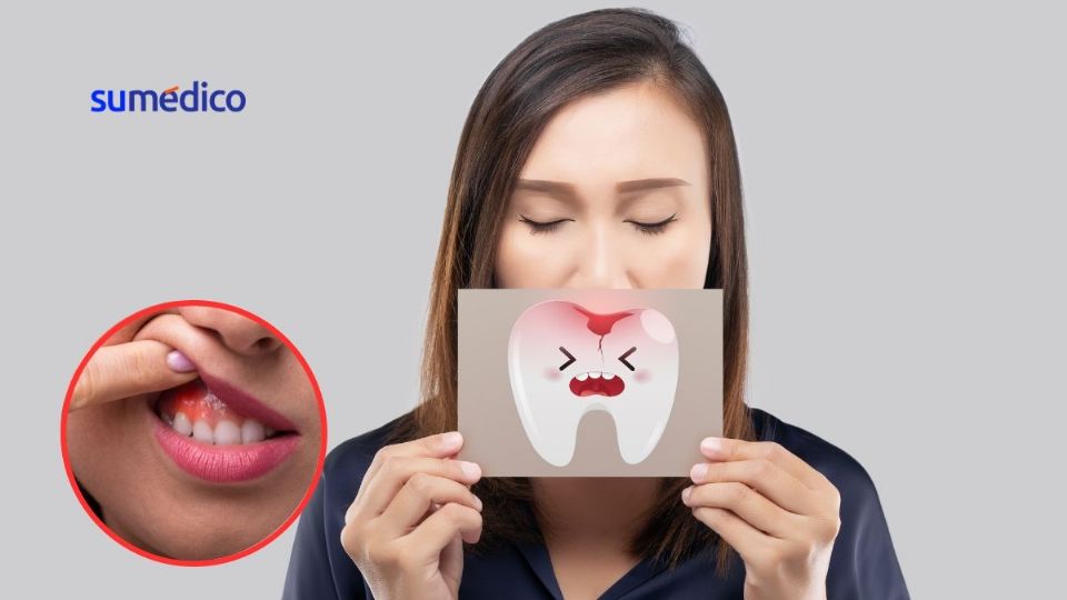 La periodontitis suele ser el resultado de no cuidar de la boca ni de los dientes por mucho tiempo.