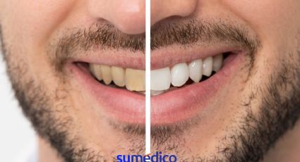 5 hábitos que hacen que tus dientes se pongan amarillos