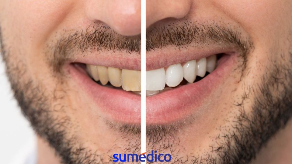 Conoce qué hábitos hacen que los dientes se pongan amarillos