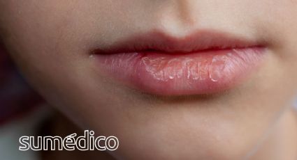 ¿Qué causa que los labios se agrieten? Conoce estas soluciones caseras